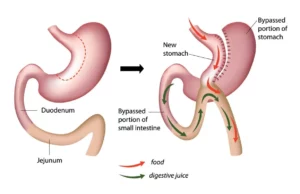 Mini-Magenbypass vs. Magenbypass