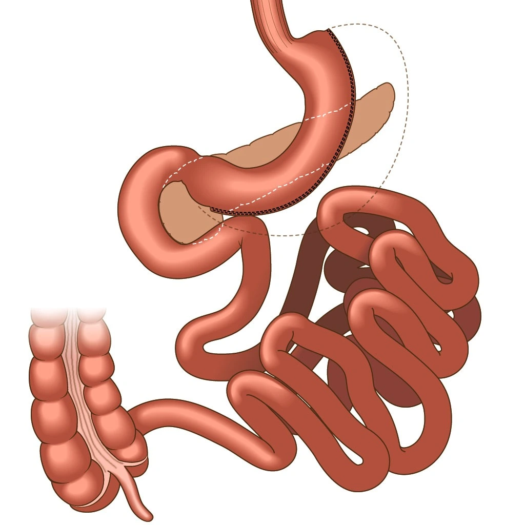 Transit Bipatiotion Diabetes-Operation-Türkei